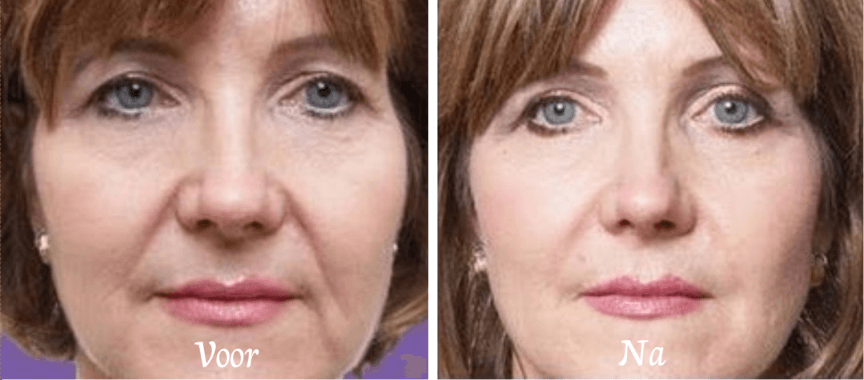 marionetlijnen dreamclinics