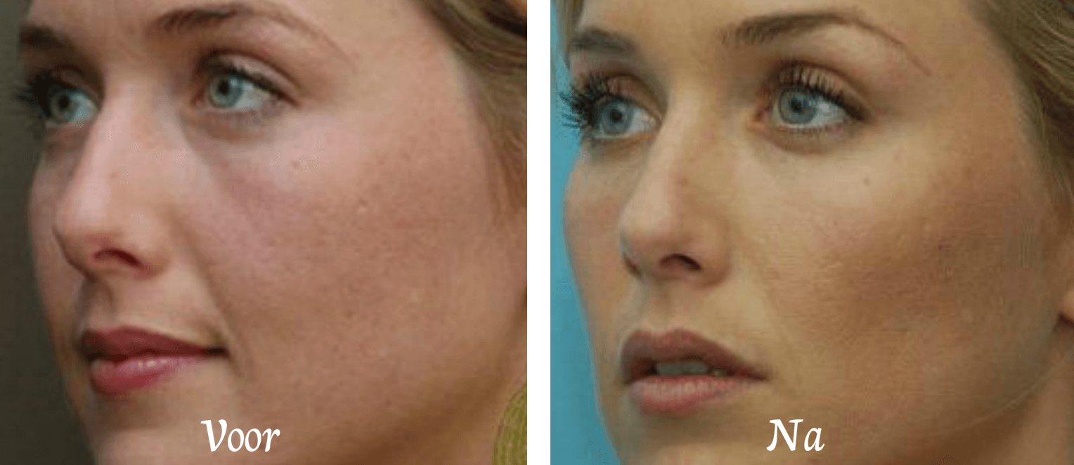 wangen-en-jukbeenderen dreamclinics