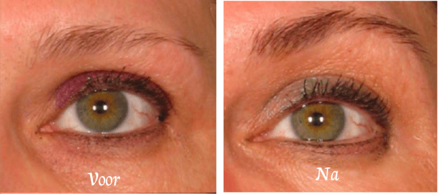 wenkbrauwlift dreamclinics