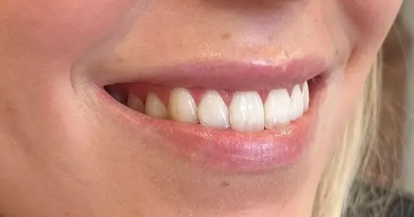 Alles Wat Je Moet Weten Over de Lipflip