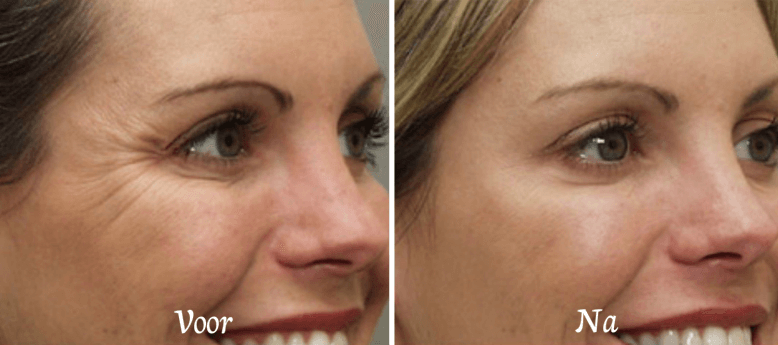 kraaienpootjes dreamclinics